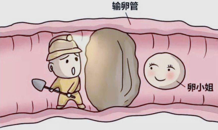 为什么会有输卵管堵塞，哪类人容易输卵